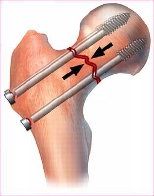 老年人骨折是什么骨折,老年人骨质疏松腰部骨折怎么办