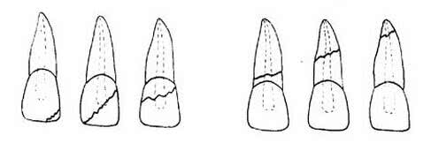 牙齿靠近牙龈的地方烂出一条缝,牙齿裂开了一条缝怎么修复多少钱