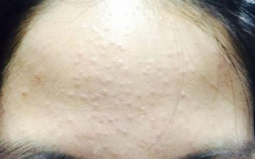 额头密密麻麻的小点点怎么去除,额头上凸起的小疙瘩怎么去除