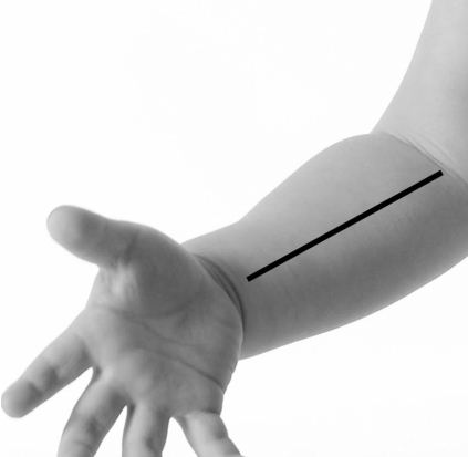 儿童扁桃体肥大最简单的偏方,小儿扁桃体肥大反复发炎怎么办