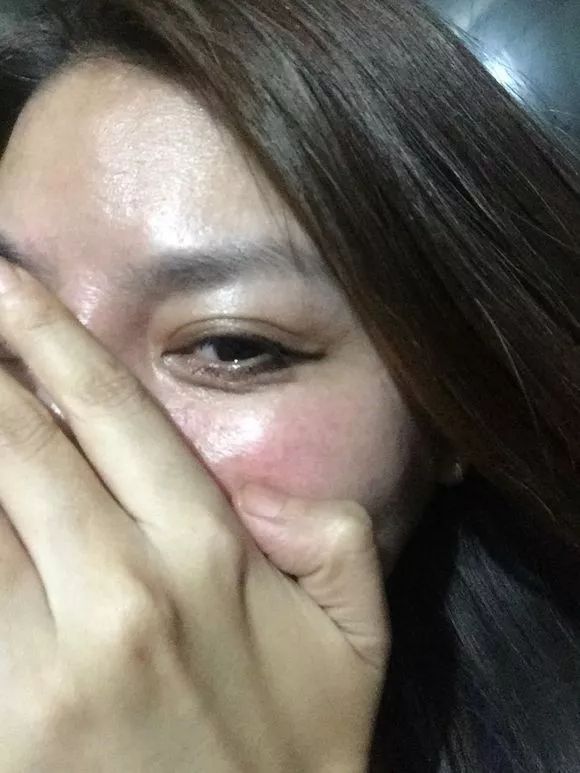 41岁考虑线雕和拉皮哪个好,线雕40岁后的感受