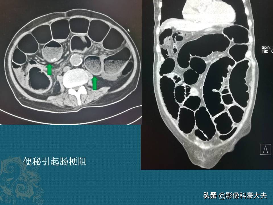 6天没排便，住院洗肠，孩子埋怨浪费3000块