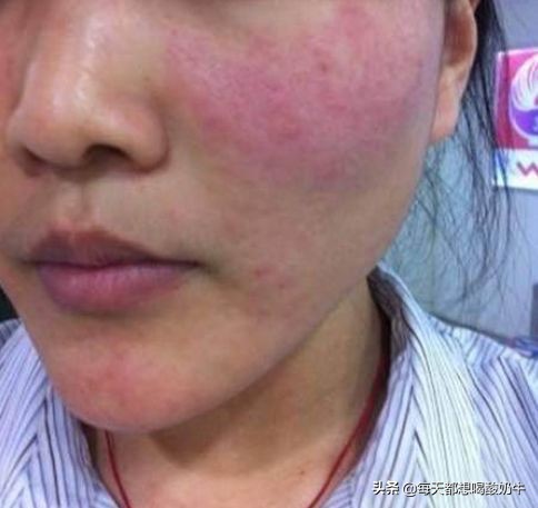 如何改善脸上皮肤特别薄，一直泛红，毛孔粗大，*血丝红**明显？