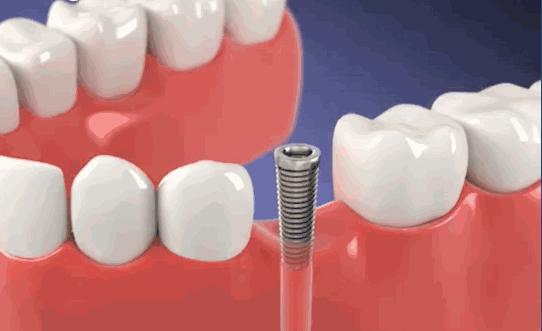 日照口腔医院种牙价目表,日照口腔医院种植牙价目表