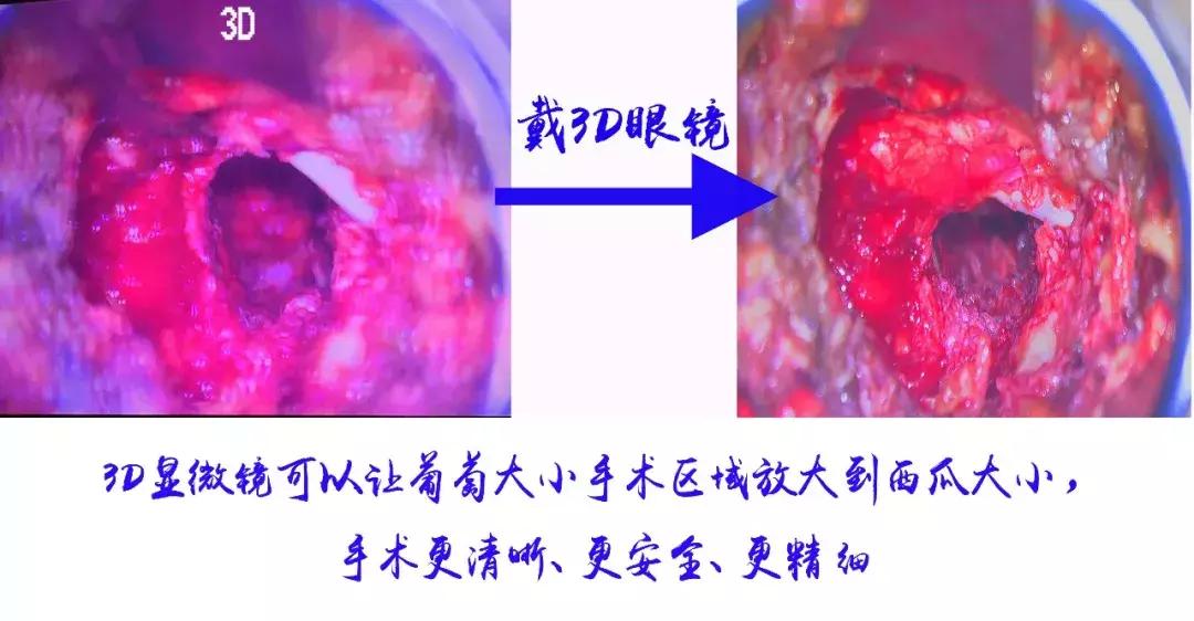 什么人适合微创手术治疗腰突,可视放射性治疗腰突效果怎么样