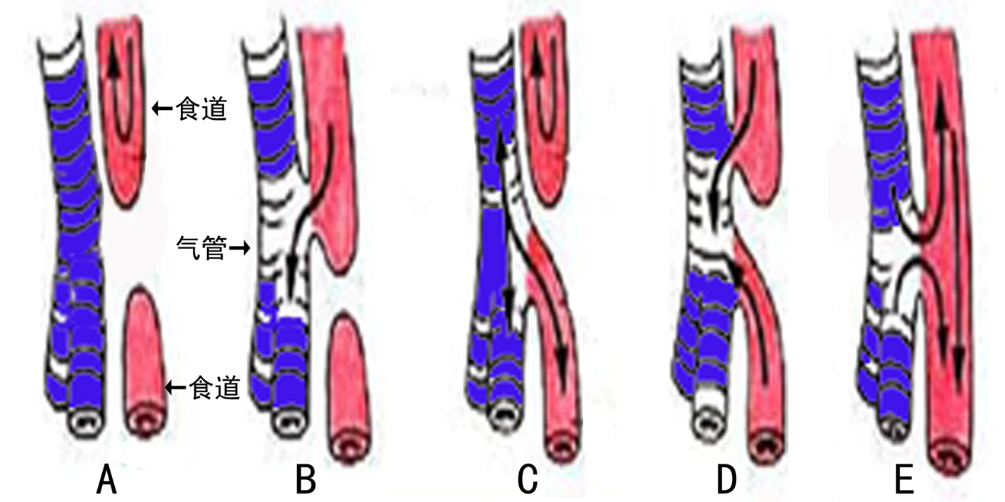 食道闭锁一般伴随什么畸形,胎儿消化道畸形超声能看出来吗