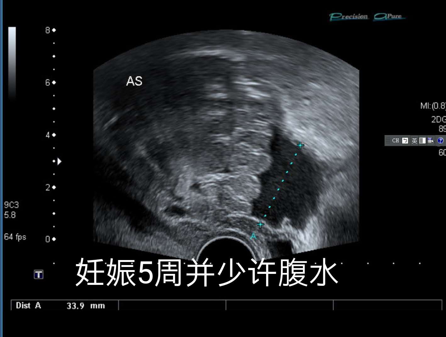 双胞胎，一个在宫内，一个躲宫外。孕妈生命垂危，医生妙手回春！