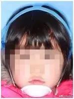 狗狗乳牙地包天怎么办,儿童乳牙地包天怎么办