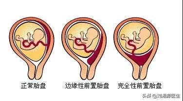 孕期反复流血跟免疫有关系吗,免疫相关不良妊娠答疑解惑