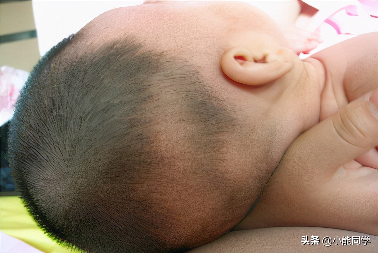 孩子头发稀是缺啥,孩子头发稀黄就是营养不良吗