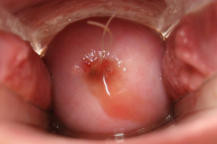 宫内节育器和节育环有什么区别,宫内节育器避孕环