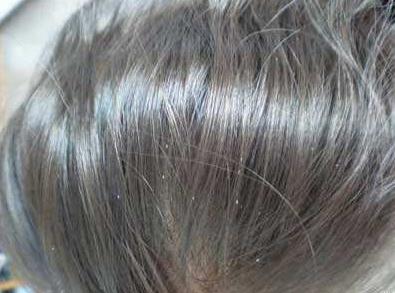 以前农村生活有虱子,为什么以前人长虱子现在没有虱子