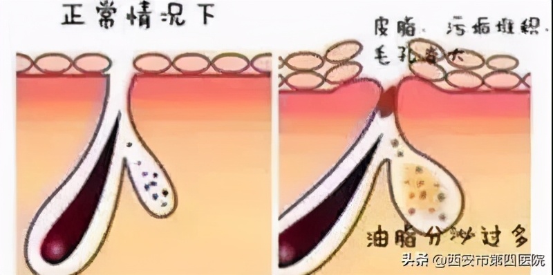 脸上毛孔大靠什么医美解决,毛孔粗大如何正确护肤