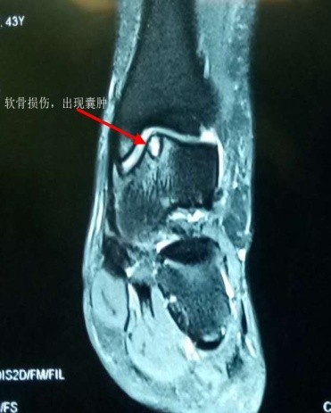 踝关节扭伤打绷带的图片,踝关节扭伤消肿治疗方法