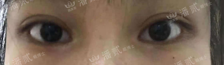 女孩眼部整形失败,内眼角整形失败