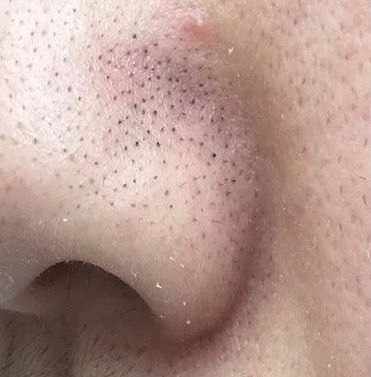 黑头反复的长还用清理吗,黑头反复长脸上老出油