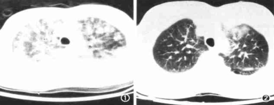 56岁男性发现双肺数百个结节,肺部肿块伴胸腔积液