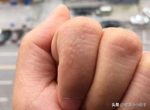手指到夏天就会有水泡是怎么回事,夏天起小水泡用什么药