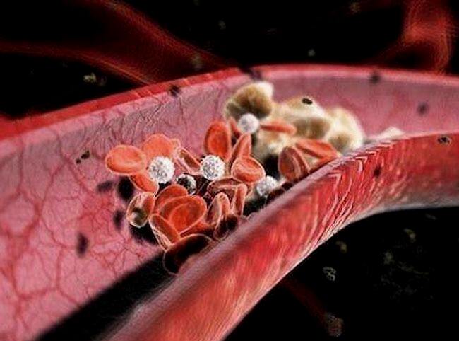 肾结石可以引起尿液红细胞升高吗,肾结石能导致大便有血吗