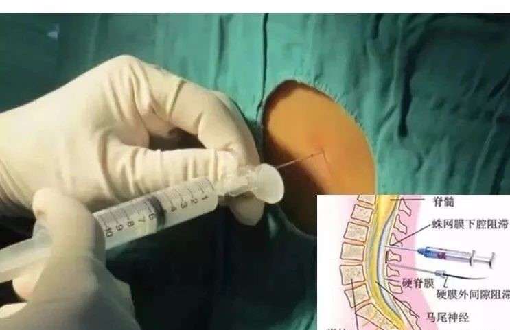 什么是无痛分娩,什么是无痛分娩仪