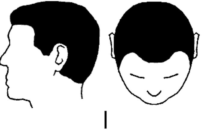 中年男性脱发原因及治疗方法,中年男性遗传性脱发能治好吗