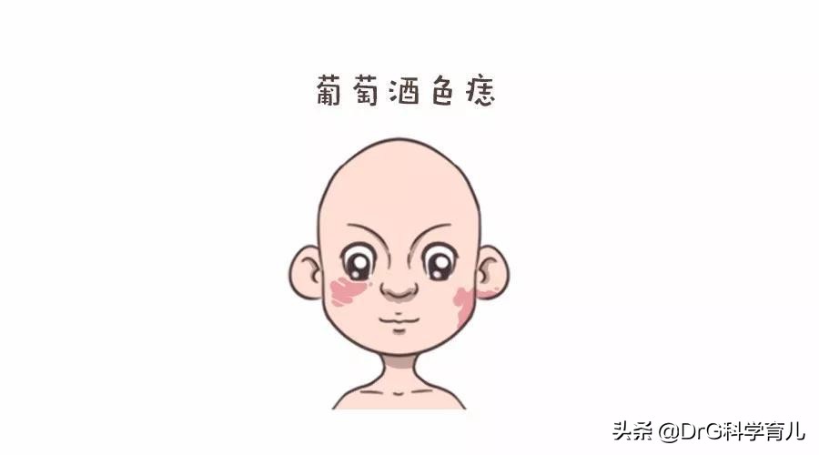 天生胎记黑毛痣会癌变会死吗,脖子上有个黑色胎记会癌变吗