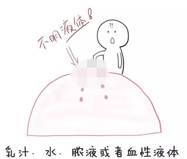 乳头溢液莫轻视，可能是身体发出的求救信号