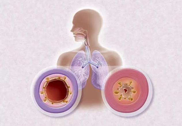 慢阻肺患者吸氧的害处,慢阻肺患者需要长期氧疗吗