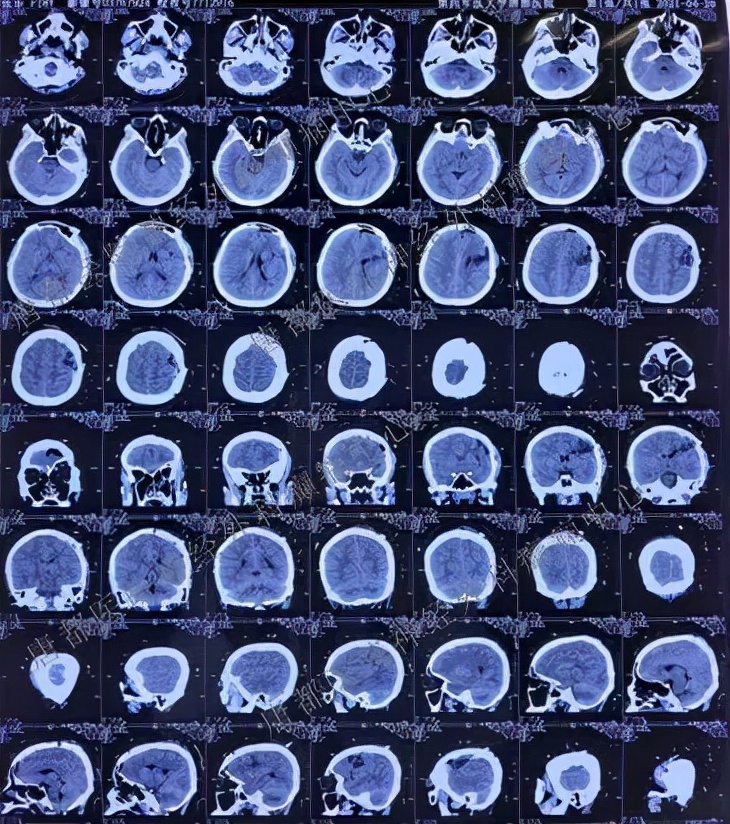 唐都医院癫痫手术能不能根治癫痫,唐都医院神经外科癫痫