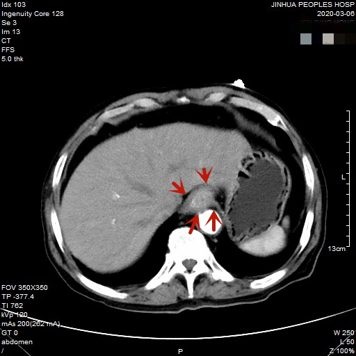 贲门癌80岁手术好还是保守治疗好,医生建议80岁老人做贲门癌手术