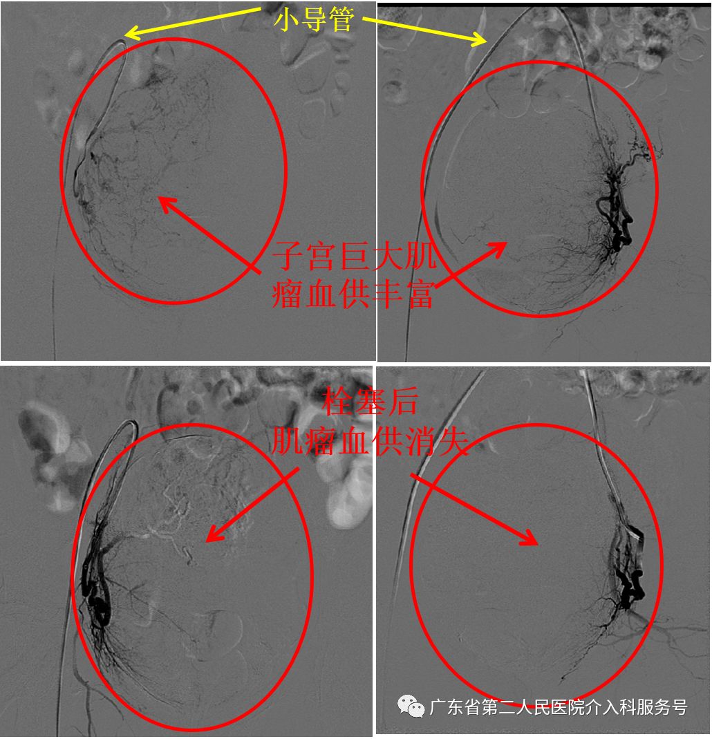 子宫肌瘤引起大姨妈一直来怎么办,子宫肌瘤大姨妈多怎么办
