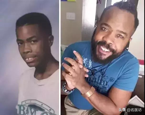 牙齿矫正换脸视频,牙齿矫正颜值有多大改变图片