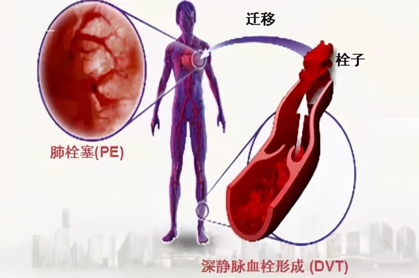 动脉血管堵用什么药,动脉和静脉血管堵哪个严重些