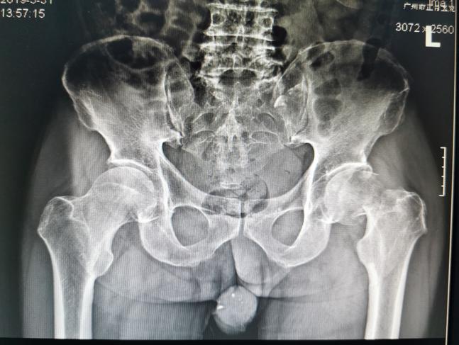 股骨颈骨折导致股骨头坏死的原因,股骨颈骨折如何避免股骨头坏死