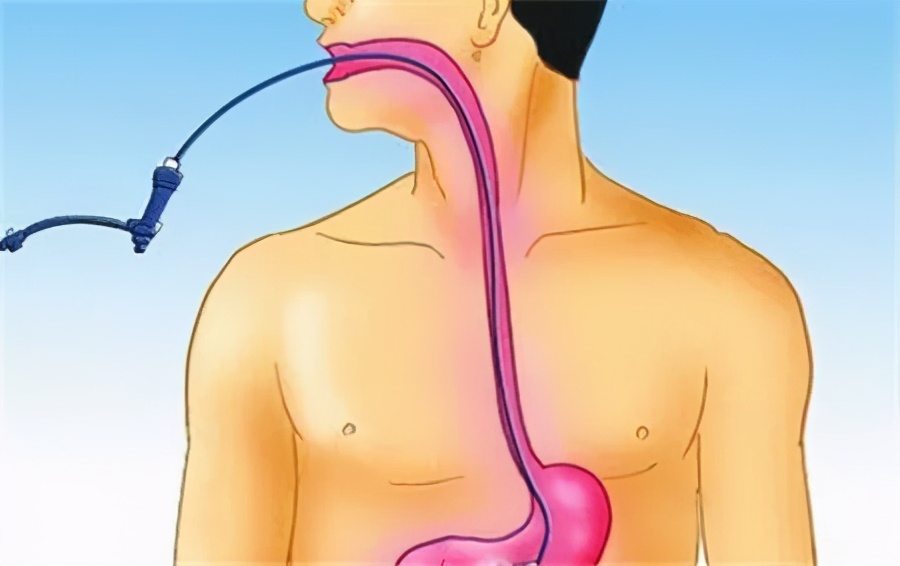 做胃镜无痛好还是普通胃镜好,做胃镜是无痛好还是普通胃镜好