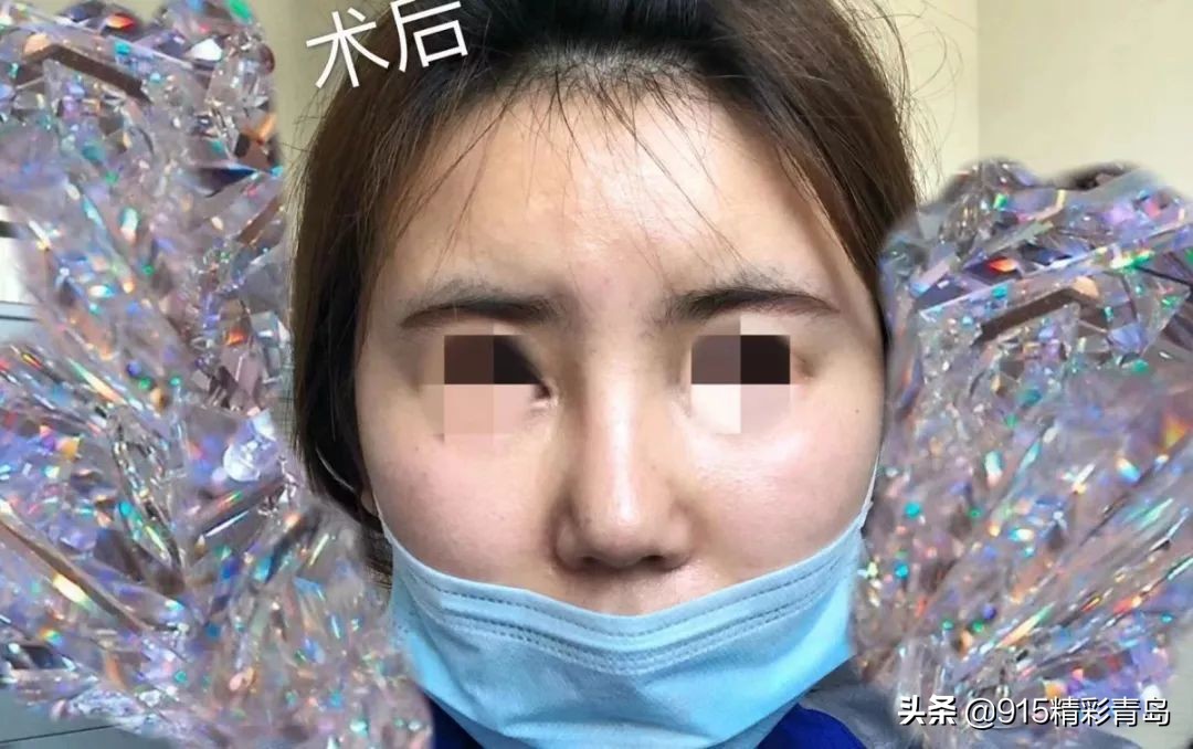 诺德整形医院失败案例,诺德整形鼻子