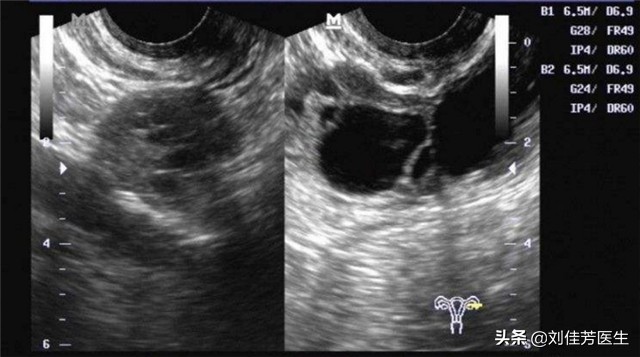 疏通输卵管堵塞的最佳时间和方法,出现输卵管堵塞怎么疏通最快