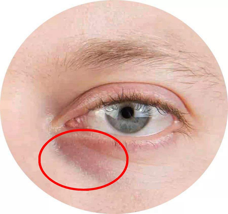 去熬夜型黑眼圈,去黑眼圈眼袋熬夜党福音