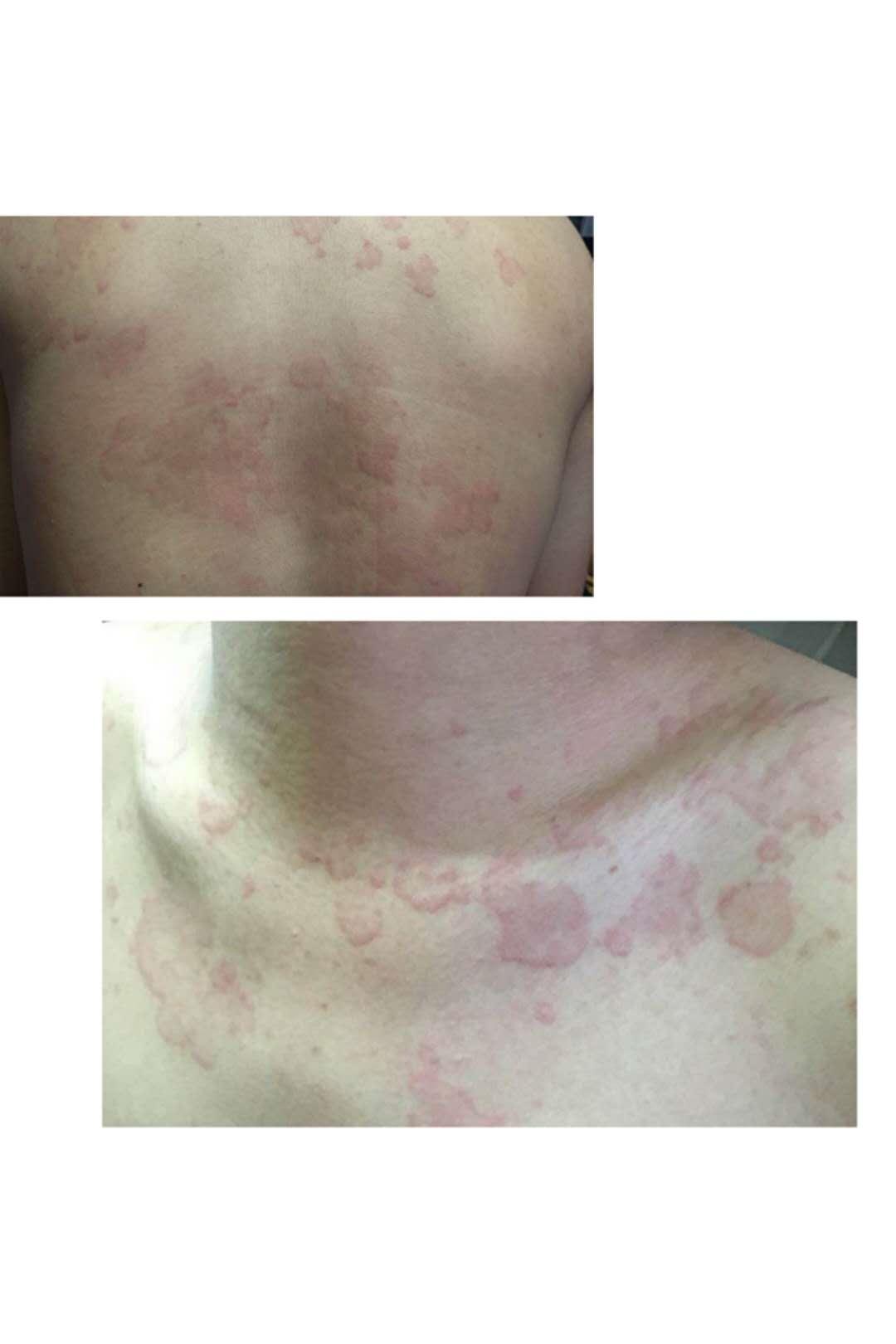 湿疹5年,7年湿疹