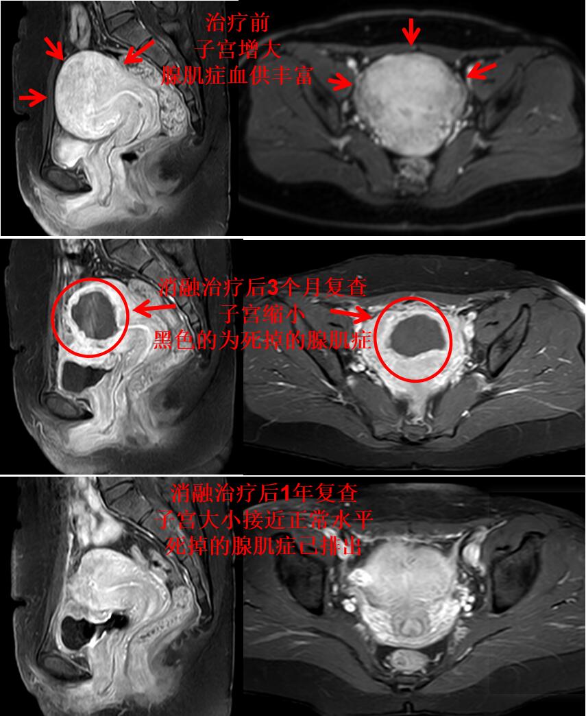 看看痛不欲生的子宫腺肌症痛经专业领域的看法与典型病例