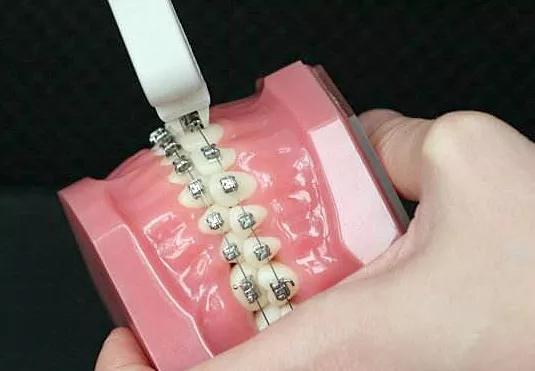 戴牙套前必须知道的事,戴牙套全过程及后期问题