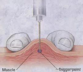 引起颈肩疼痛的原因有哪些,引起颈肩痛和腰腿痛的主要原因