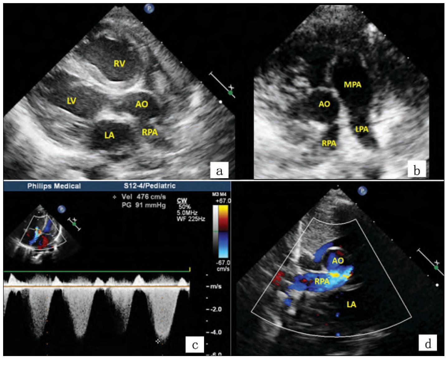 肺出血肾炎综合征是由什么导致的,肺出血肾炎综合征有多罕见