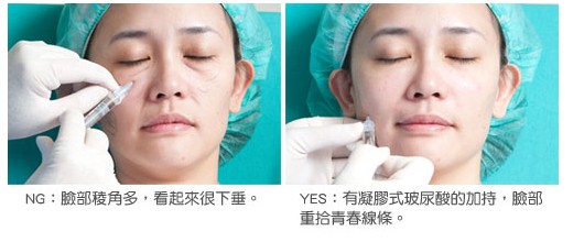 祛颈纹注射除皱和射频除皱哪个好,光电除皱和注射除皱哪个好啊