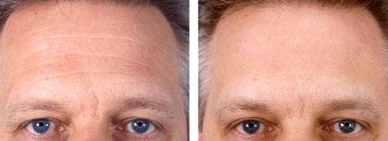 如何消除眼角皱纹和抬头纹的方法,消除川字纹和抬头纹最有效的方法