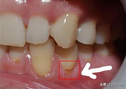 刷牙姿势不对导致补牙,刷牙姿势不对导致牙龈有裂痕