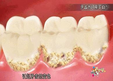 刷牙去牙垢烟垢黄牙最有效方法,刷牙多久才能消除牙黄味