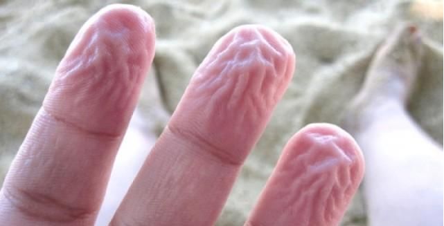 为什么手指泡水会有坑,手指为什么泡水特别容易烂