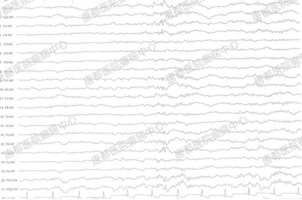 颞叶海绵状血管瘤癫痫微创手术,唐都医院脑肿瘤微创手术
