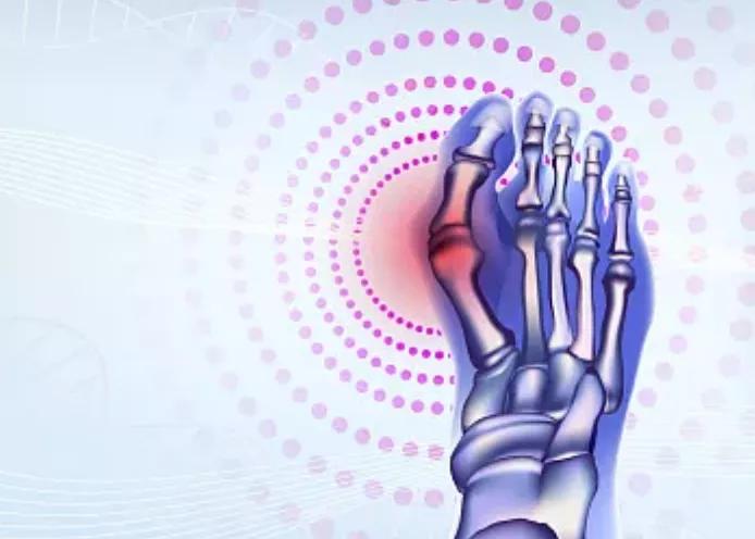 预防痛风发作的四个动作操,痛风者有救了四个小妙招缓解痛风